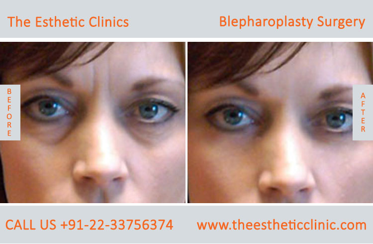 Blepharoplasty Surgery, Eyelid lift surgery before after photos in mumbai india (1)